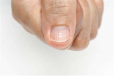 what causes thick fingernails